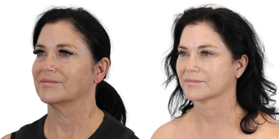 Eyelid Surgery before and after photo