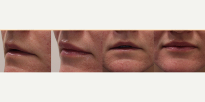 Belotero before and after photo