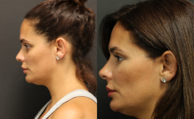 Dermal Fillers before and after photo