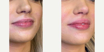 Lip Fillers before and after photo