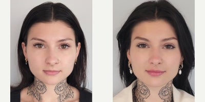 Lip Fillers before and after photo