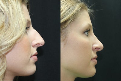 Rhinoplasty before and after photo