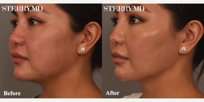Buccal Fat Removal before and after photo