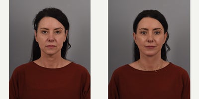 Buccal Fat Removal before and after photo