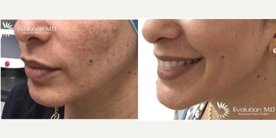 Chemical Peel before and after photo