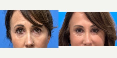 Eyelid Surgery before and after photo