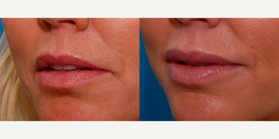 Lip Fillers before and after photo