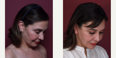 Neck Lift before and after photo