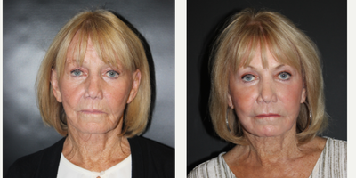 Laser Resurfacing before and after photo