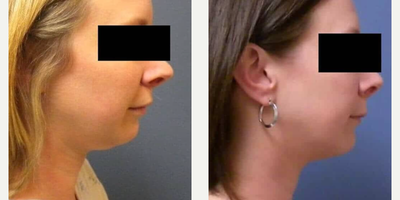 Liposuction before and after photo