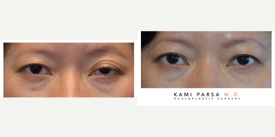Ptosis Surgery before and after photo
