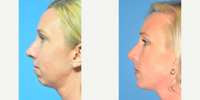 Chin Implant before and after photo