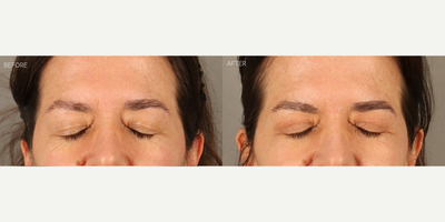 CO2 Laser before and after photo