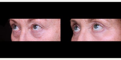 Eyelid Surgery before and after photo