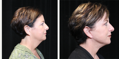 Facelift before and after photo