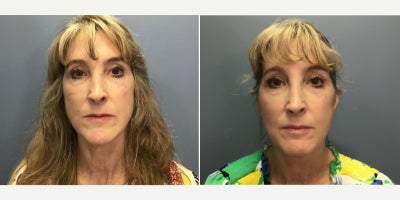 Facelift before and after photo