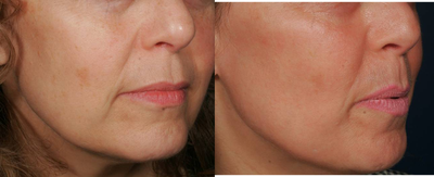 Fraxel Repair before and after photo