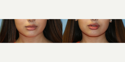 Lip Fillers before and after photo