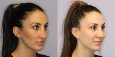 Revision Rhinoplasty before and after photo