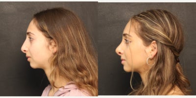 Revision Rhinoplasty before and after photo