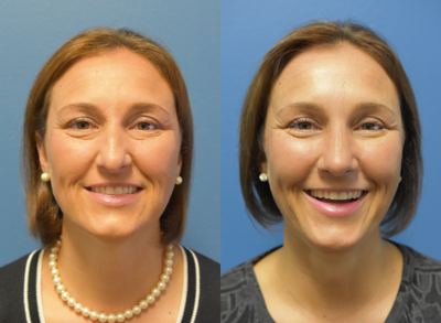 Rhinoplasty before and after photo