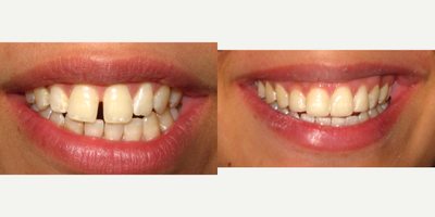 Smile Makeover before and after photo