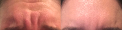 Botox before and after photo
