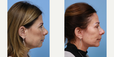 Deep Plane Facelift before and after photo