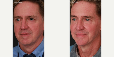 Dermal Fillers before and after photo