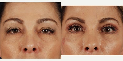 Eyelid Surgery before and after photo