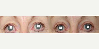 Eyelid Surgery before and after photo