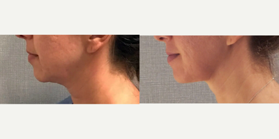 FaceTite before and after photo