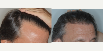 FUE Hair Transplant before and after photo