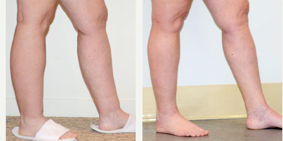 Liposuction before and after photo