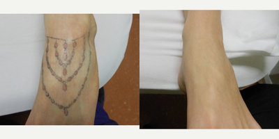 Tattoo Removal before and after photo