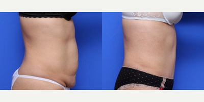 Tummy Tuck before and after photo
