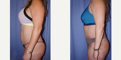 Tummy Tuck before and after photo
