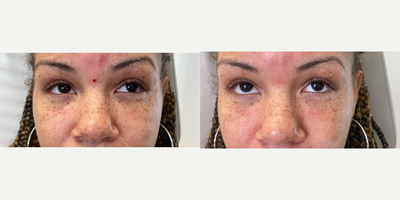 Dermal Fillers before and after photo