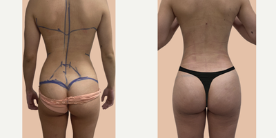 Liposuction before and after photo