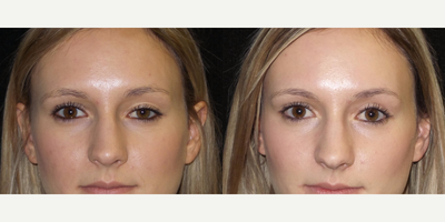 Ptosis Surgery before and after photo