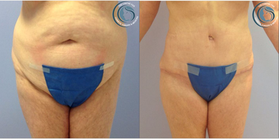 Tummy Tuck before and after photo