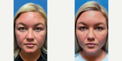 Chin Filler before and after photo