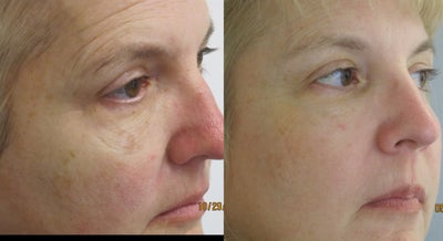 CO2 Laser before and after photo