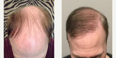 FUE Hair Transplant before and after photo