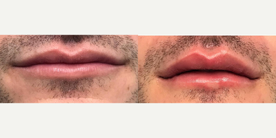 Juvederm before and after photo