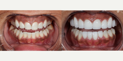 Porcelain Veneers before and after photo