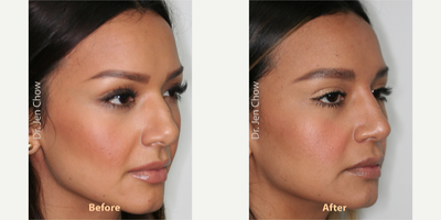 Rhinoplasty before and after photo