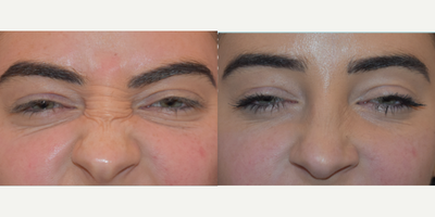 Botox before and after photo