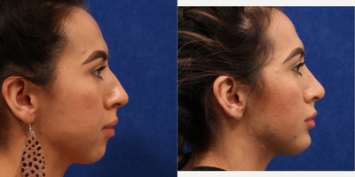 Chin Implant before and after photo