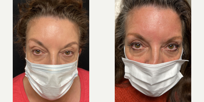 Eyelid Surgery before and after photo